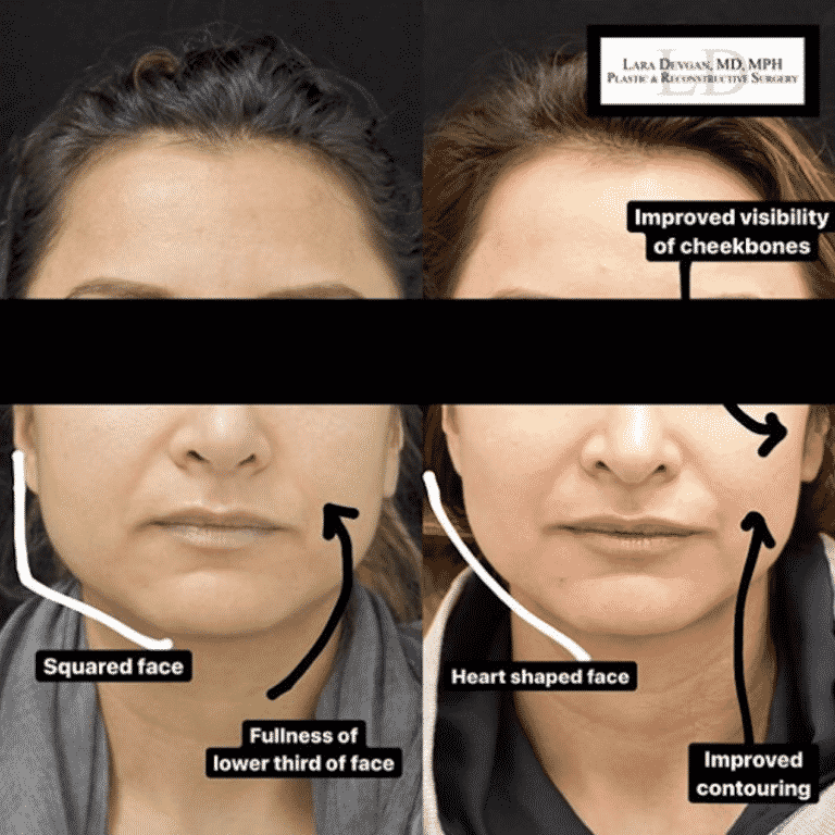 Lower Blepharoplasty Before and After Gallery  Taban MD